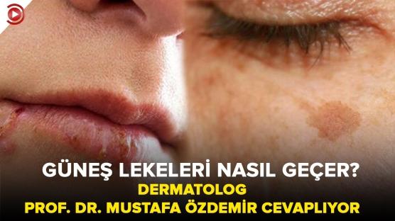 Güneş lekeleri nasıl geçer?