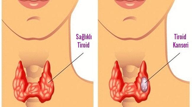 Trkiye'de en ok grlen ikinci kanser tr Tiroid kanseri kt