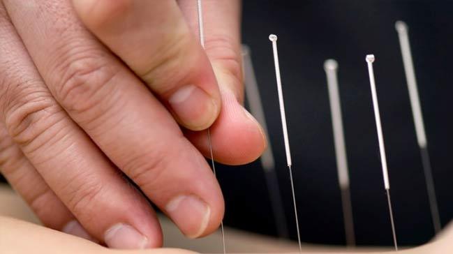 Hacamat ve akupunktur artk devlet hastanesinde!