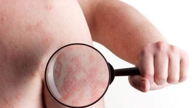Beyazlama (vitiligo) hastal yalnzca cilt hastal deildir!