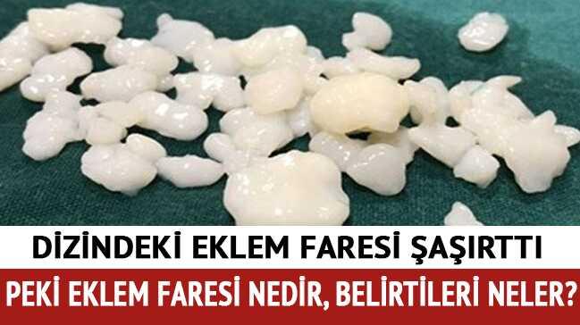 Eklem faresi belirtileri nelerdir" Eklem faresi nedir" 