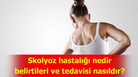  Skolyoz belirtileri ve tedavisi nasldr" Skolyoz hastal ldrr m"