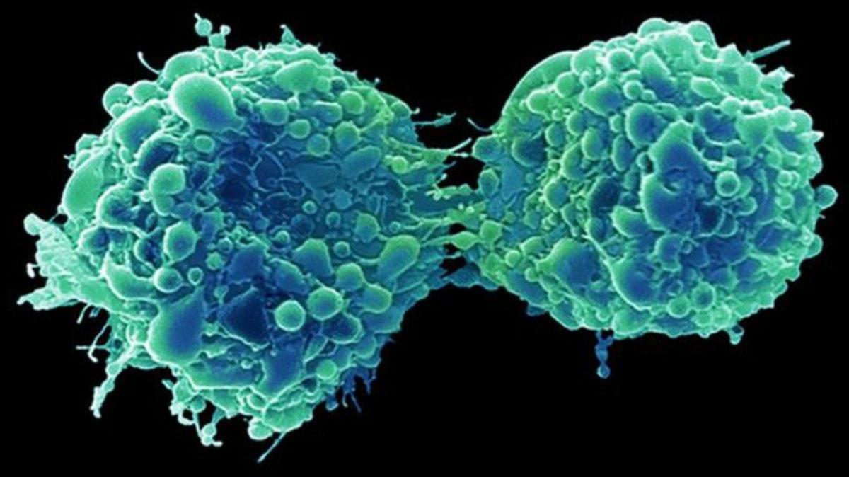 Kanserde devrim niteliinde bulu: Mesane kanseri, souk algnl virs ile ldrld