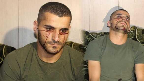 Bu hastalığa doktorlar bile şaşırıyor! 23 yaşındaki genç 'kan ağlıyor'