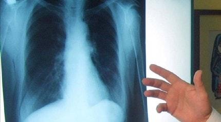 Akciğer kanseri tedavisinde yeni yöntem: İmmüno-onkoloji!