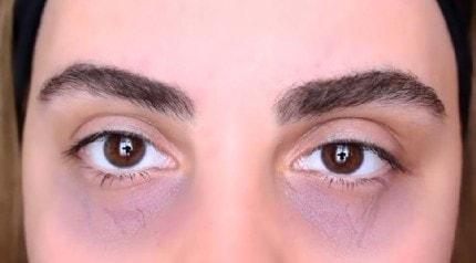Göz altı morluklarında yeni tedavi yöntemi! Hızlıca gideriliyor