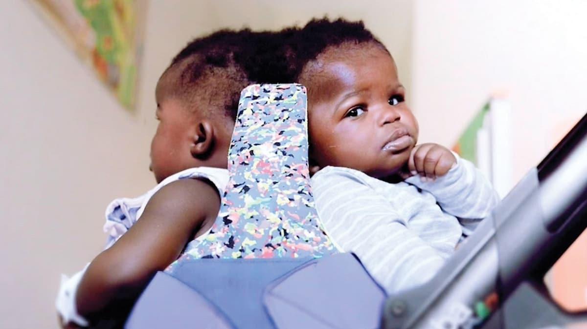Siyam ikizleri 18 saatlik operasyonla ayrld