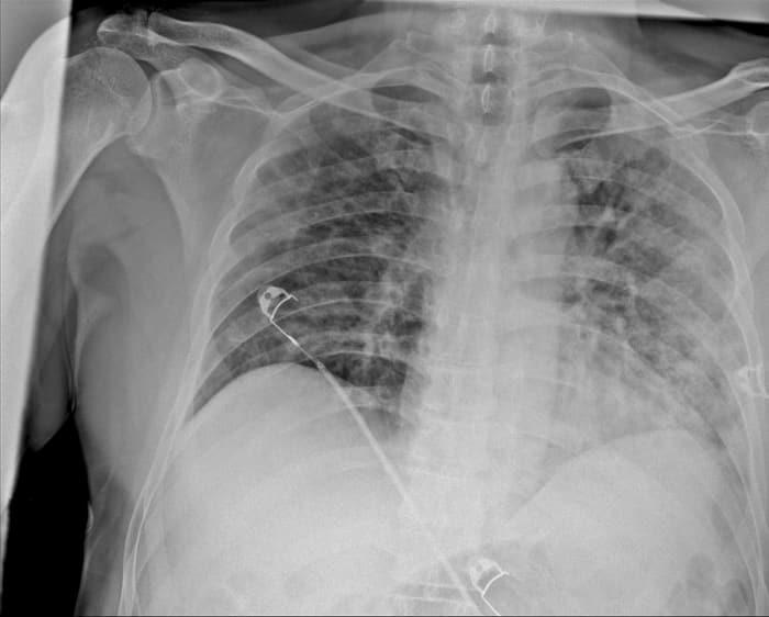 Файл cxr corona как открыть