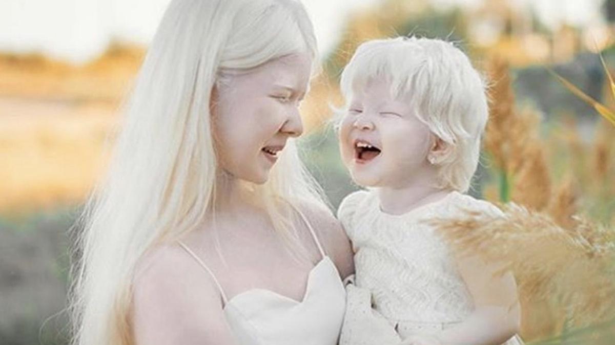 Albinizmli doan kz kardeler moda dnyasnn ilgi oda oldu