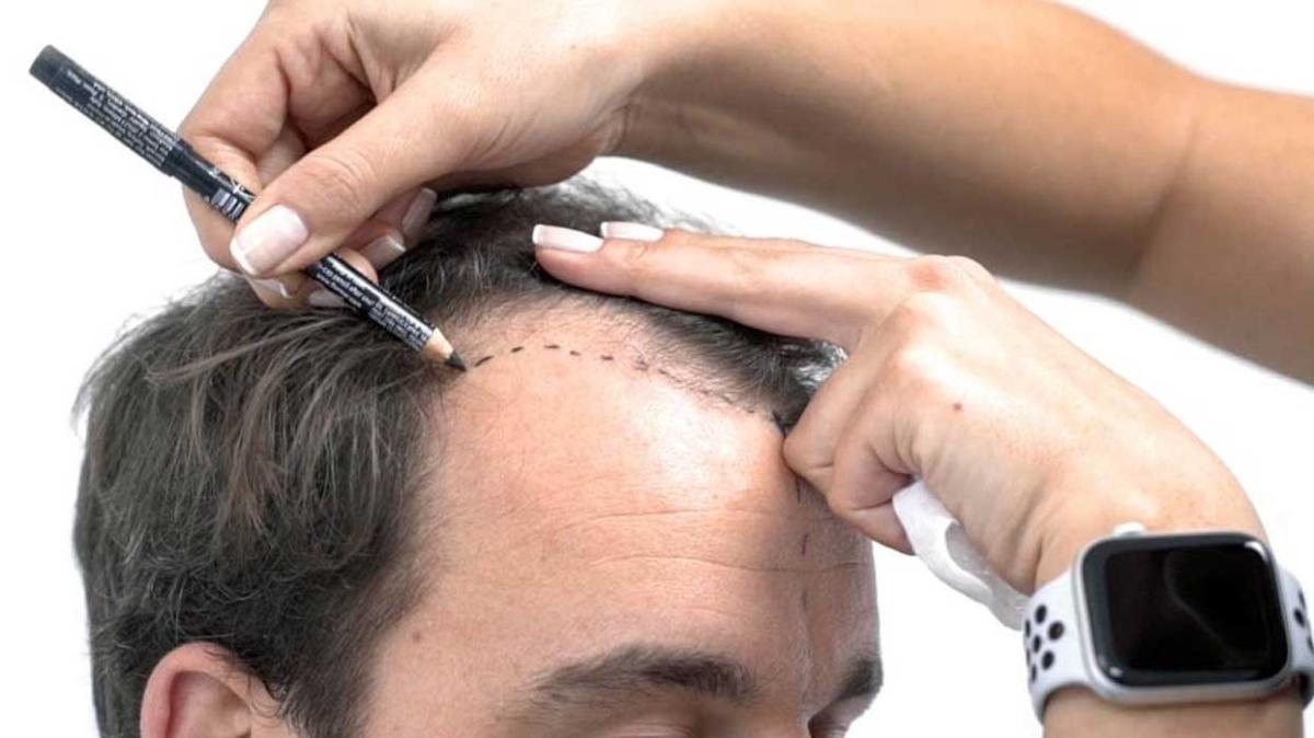 En İyi Saç Ekim Merkezi Hangisi Saç Ekimi 2022 Fiyatları Ne Kadar"