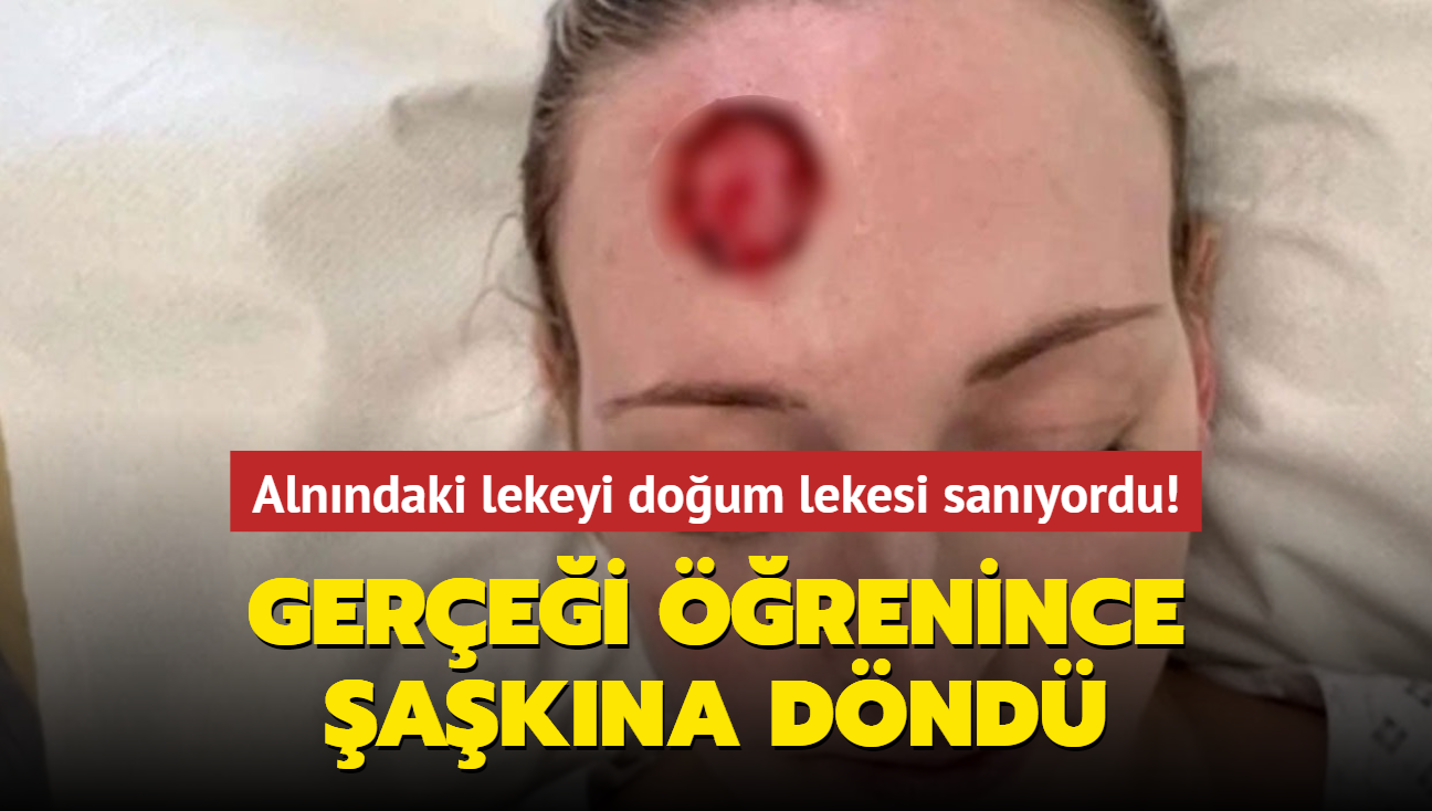 Alnndaki lekeyi doum lekesi sanyordu! Gerei renince akna dnd