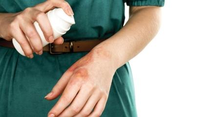 Yan��a ne iyi gelir? Yan�k tedavisi nas�l yap�l�r?