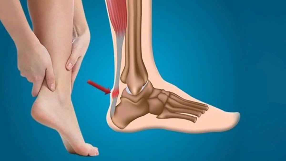Ail tendonu koparsa ne olur, tedavisi nasldr" Ail tendonu nedir, nerede bulunur" 