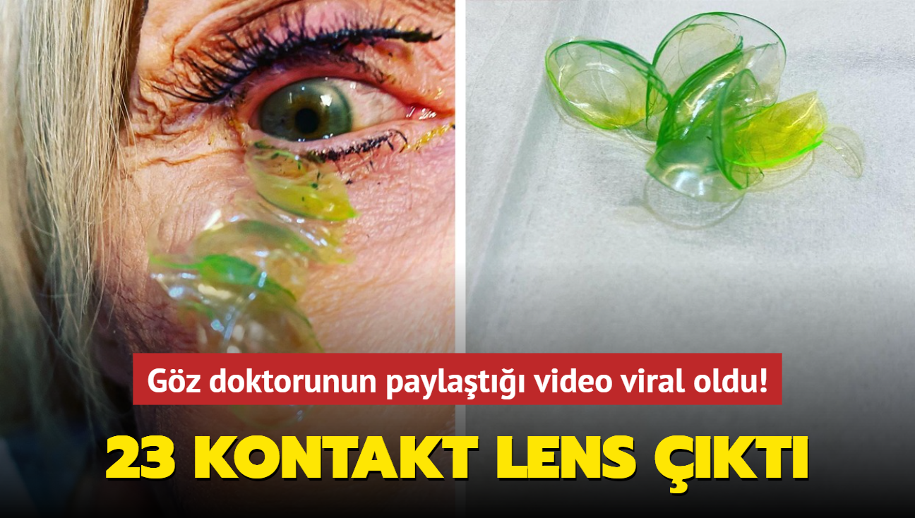 Gznden 23 kontakt lens kt! Gz doktorunun paylat video sosyal medyada viral oldu! 