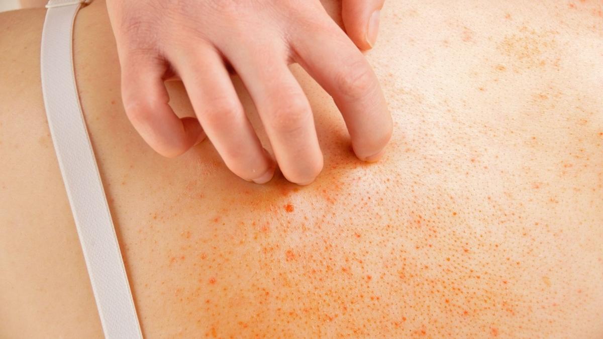 cilt bat��� k�l bat��� g�zellik cilt bat��� nas�l ge�er k�l bat��� nas�l ge�er foto�raflar� resimleri