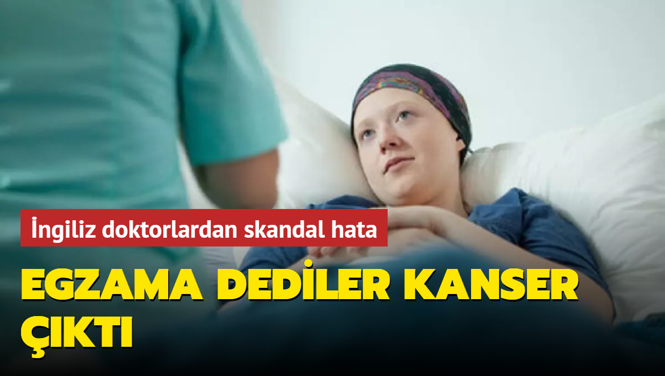 ngiliz doktorlardan skandal hata: Egzama dediler kanser kt