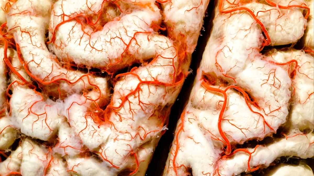 alzheimer beyin hcresi salk fotoraflar resimleri