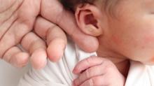Bebeklerde kepe kulak durumu geici mi? Ameliyatsz deiim mmkn m?