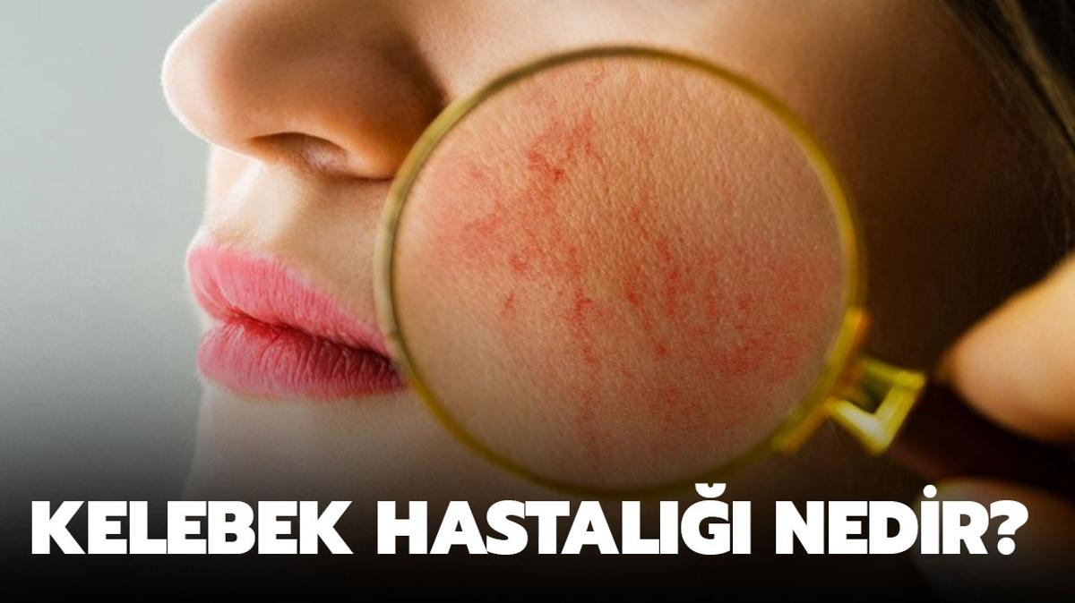 Kelebek hastal nedir, neden olur" Kelebek hastal nasl tedavi edilir"