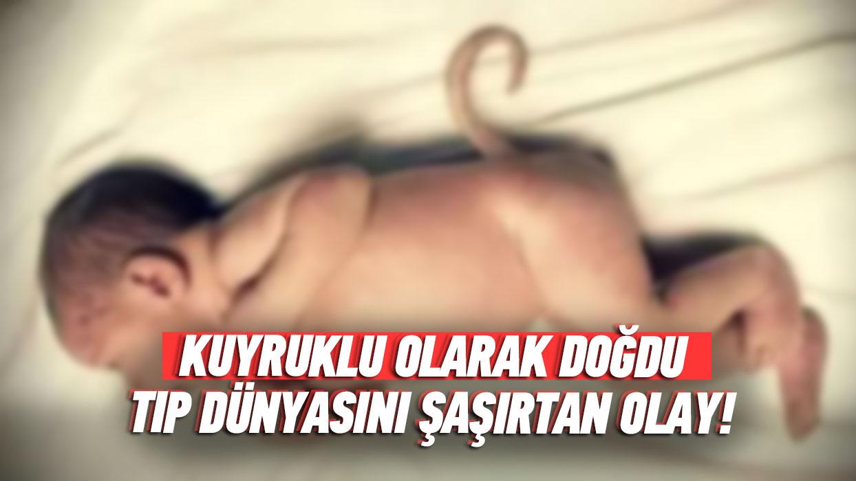 Hindistan'da tp dnyasn artan olay! Kuyruklu bebek dnyaya geldi