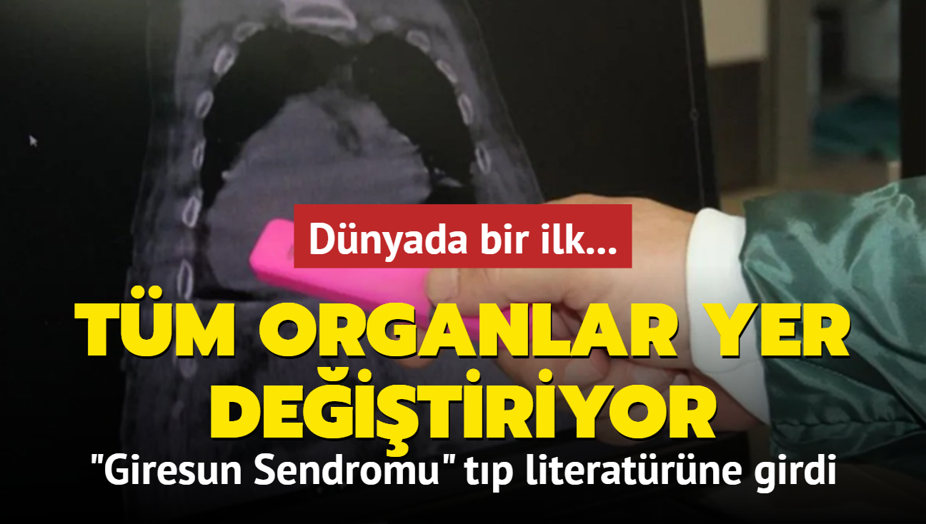 Dnyada bir ilk... 'Giresun Sendromu' tp literatrne girdi: Tm organlar yer deitiriyor