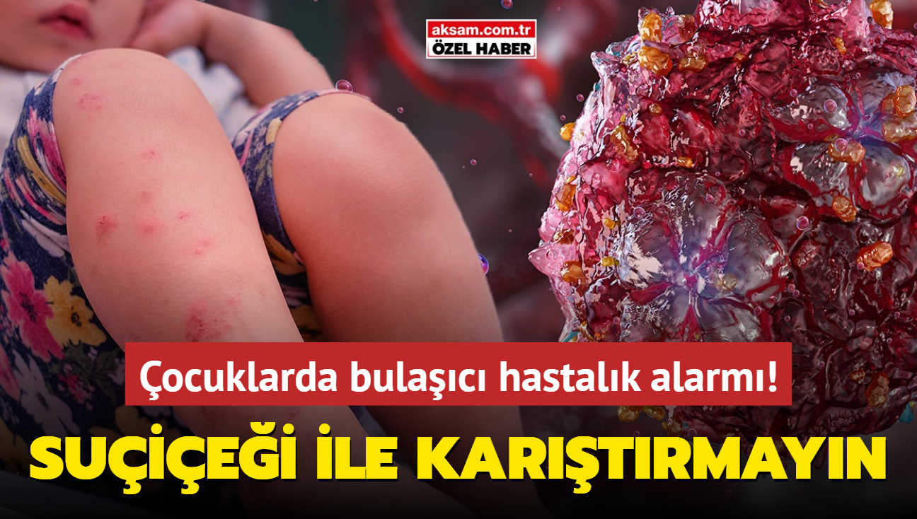 ocuklarda bulac hastalk alarm! Suiei ile kartrmayn! Atele balyor...