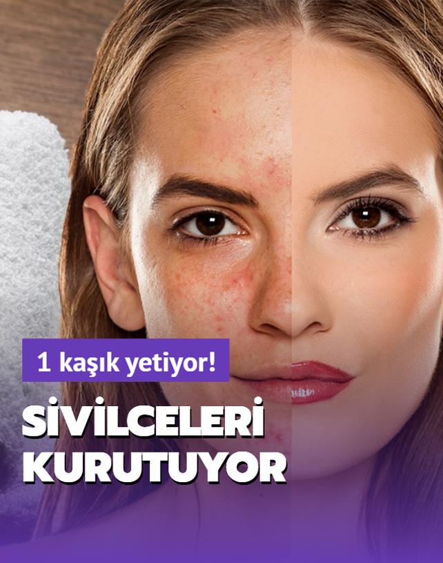 1 kak yetiyor! Sivilceleri kurutuyor, ciltteki lekeleri ayor