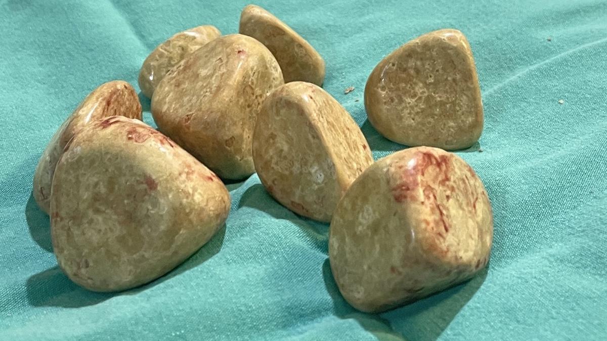 Mesanesinden 370 gram ta kt