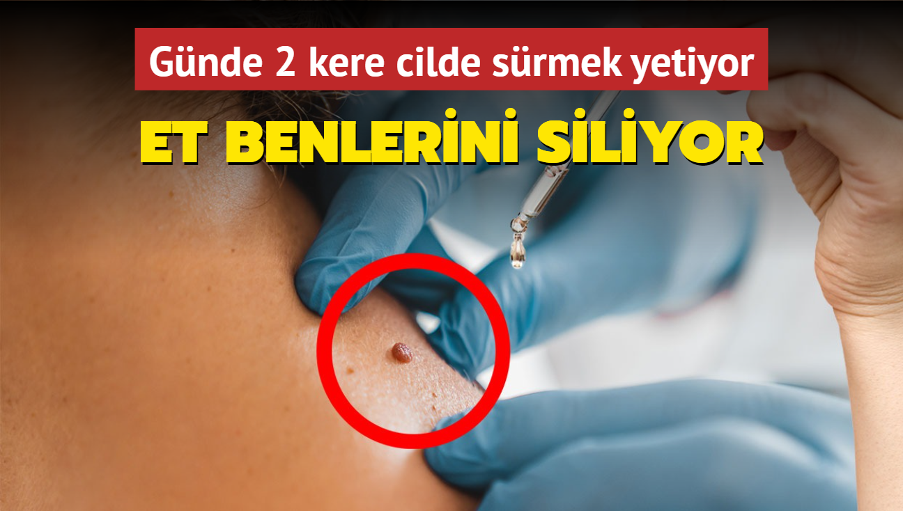 Et benlerinden kurtulmak bu kadar kolay! Gnde 2 kere cilde srmek yetiyor