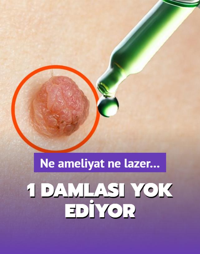 Karbonata 1 damla ekleyince et benini yok ediyor! Ne ameliyat ne lazer