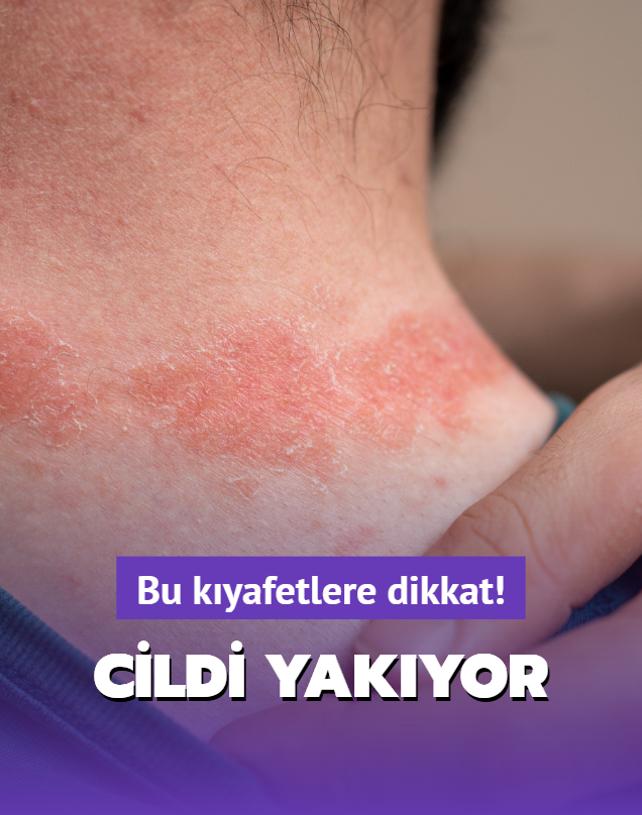 Bu kuma trn giyenin cildi yand! te dermatologlarn nerisi