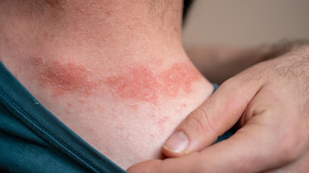 Bu kuma trn giyenin cildi yand! te dermatologlarn nerisi