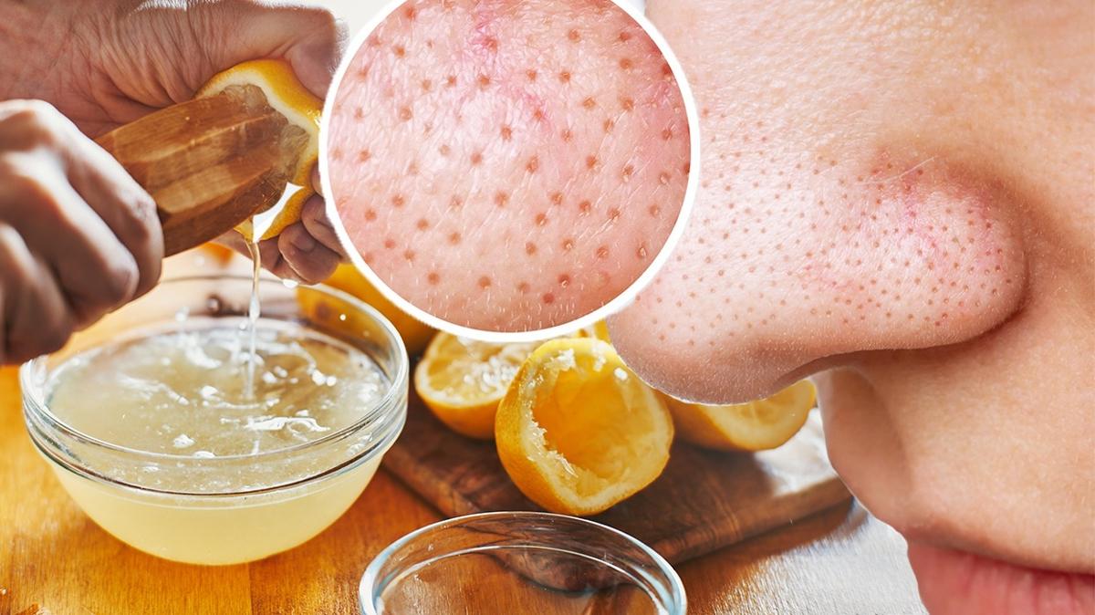 Siyah noktalara limonlu zm! Yava ama etkili...