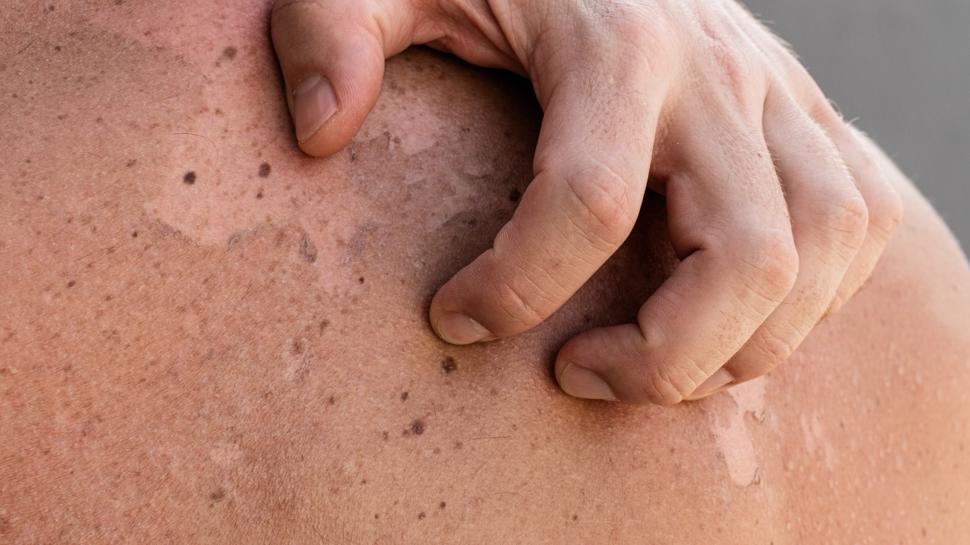 Lekeler ve kabart cilt kanseri belirtisi olabilir