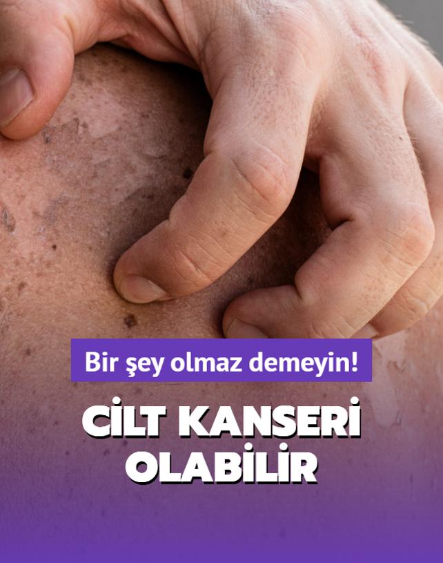 Lekeler ve kabart cilt kanseri belirtisi olabilir