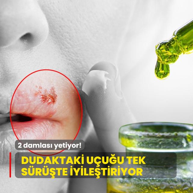 Uuk derdine son: 2 damlas yetiyor! Dudaktaki uuu tek srte iyiletiriyor