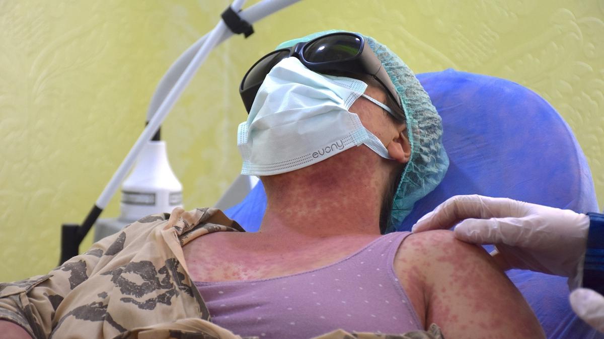 Vanda krem reaksiyonu Yanma kzarklk ikayeti Hastaneye bavuru fotoraflar resimleri