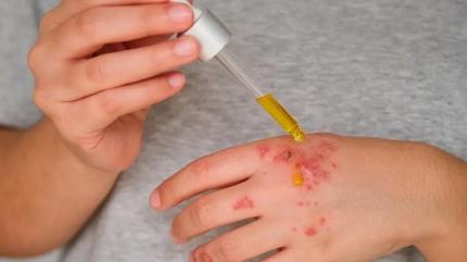 Mantara kesin zm! Egzama ve sedefin kkn kazyor: 1 damlas gnlerce cildi yumuack yapyor