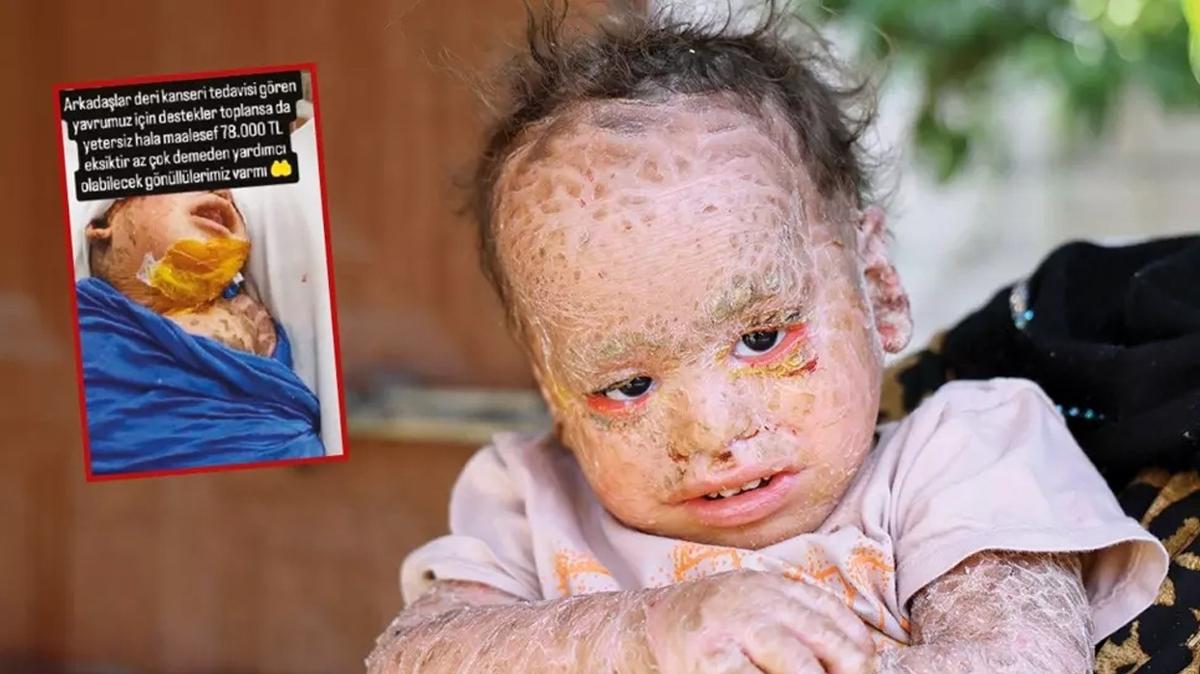 anlurfa kelebek hastal balk pulu hastal yusuf timuin tedavi sosyal medya sosyal medya hesab sahte ilan dolandrc fotoraflar resimleri