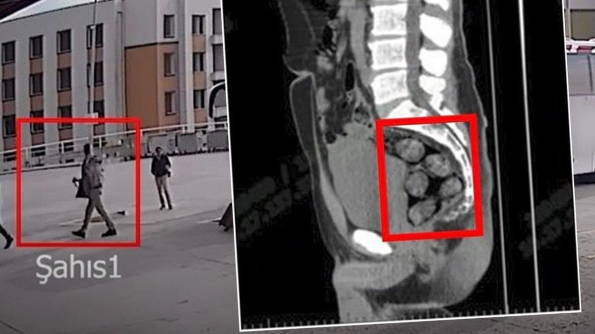 tomografi Uyuturucu  mide fotoraflar resimleri