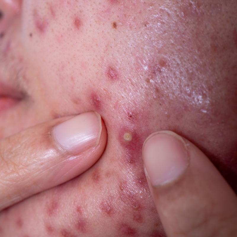 Beyaz sivilceleri 15 gnde kurutuyor! Kremlere son, iltihapl sivilcelerden kurtaryor