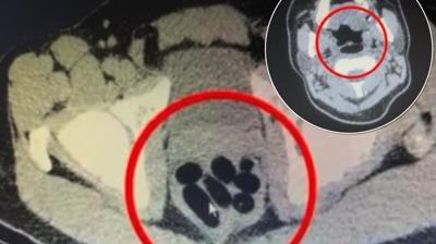 Midesinden kanlar hayrete drd! Gzaltna alnd