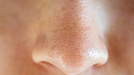 Yzdeki siyah noktalarn comasna sebep olan 2 yiyecek