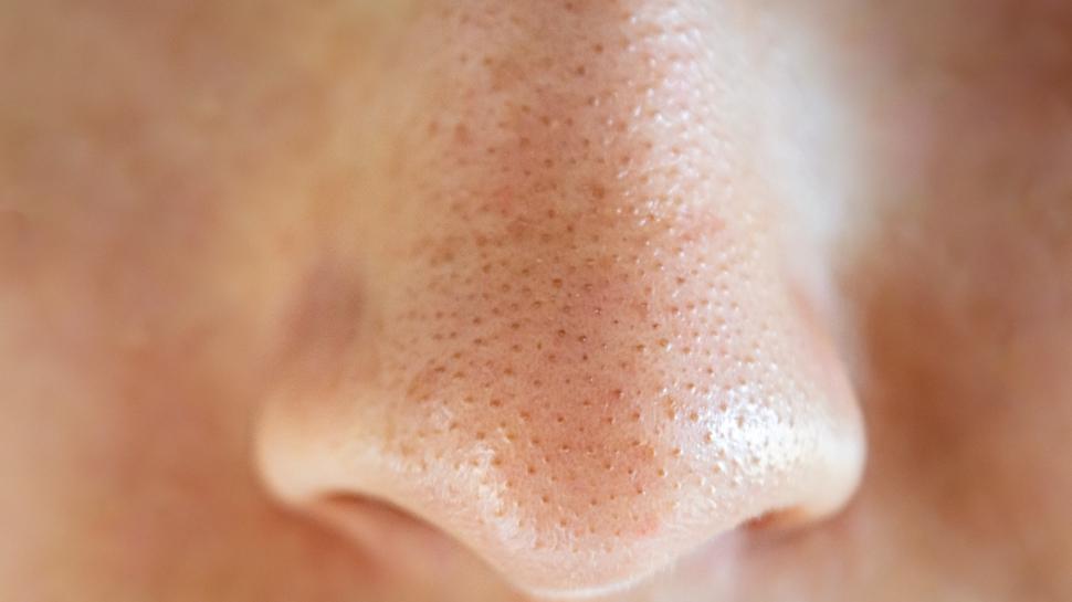 Yüzdeki siyah noktaların coşmasına sebep olan 2 yiyecek