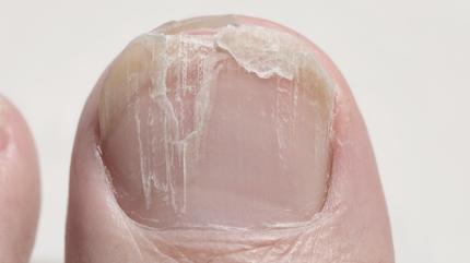 Trnak krlnca parmaklar iyiletiren doal kr: Ne ar ne sz kalyor