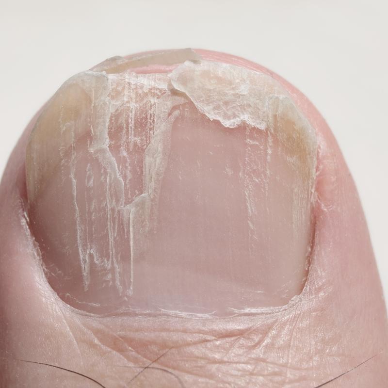 Trnak krlnca parmaklar iyiletiren doal kr: Ne ar ne sz kalyor