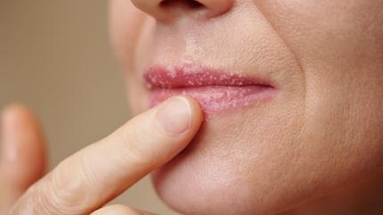 Demir eksikli�inin 7 belirtisi: Kendini soluk dudaklardan belli ediyor