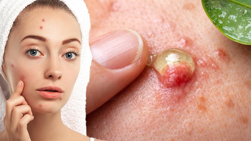 İltihaplı sivilceyi anında eritiyor! Asit gibi etkisi var, 1 damlası sivilceyi kurutuyor