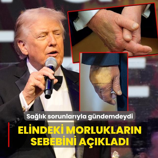 Sa�l�k sorunlar�yla g�ndemdeydi... Elindeki morluklar�n sebebini a��klad�