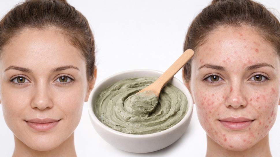 Sivilceleri kurutuyor! 10 dakikada gelen güzellik